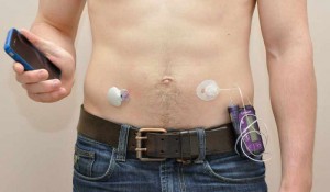 Artificial-Pancreas