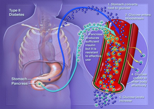 type-2-diabetes